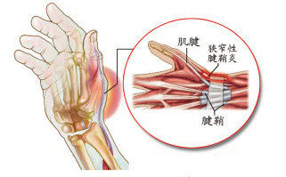 腱鞘炎